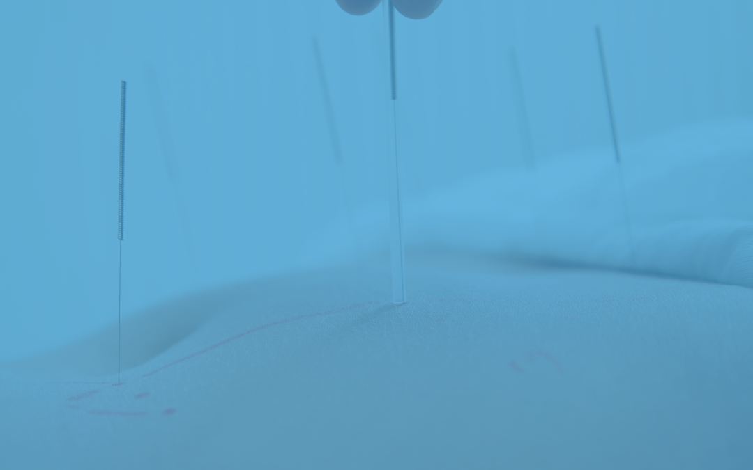 Agopuntura a Darfo Boario Terme Valle Camonica